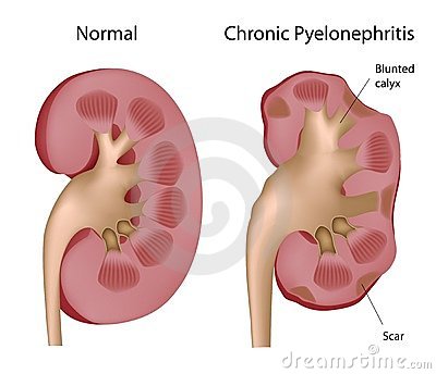 Riñon con pielonefritis